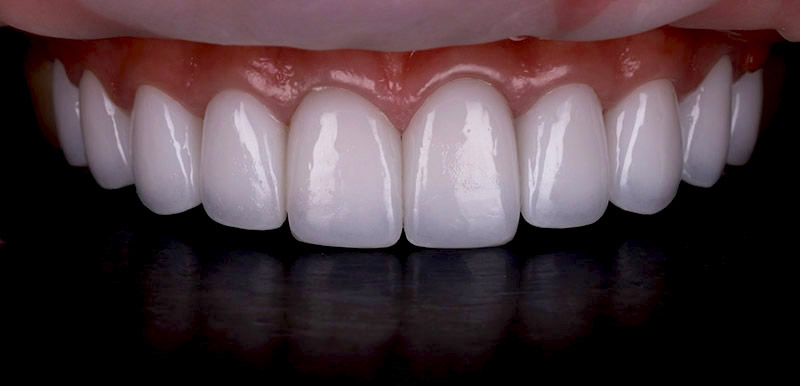 女星詩亞陶瓷貼片重做後一個月回診照,關閉牙縫黑三角同時維持自然的牙齒外觀,且牙齦維持健康粉色的貼合狀態