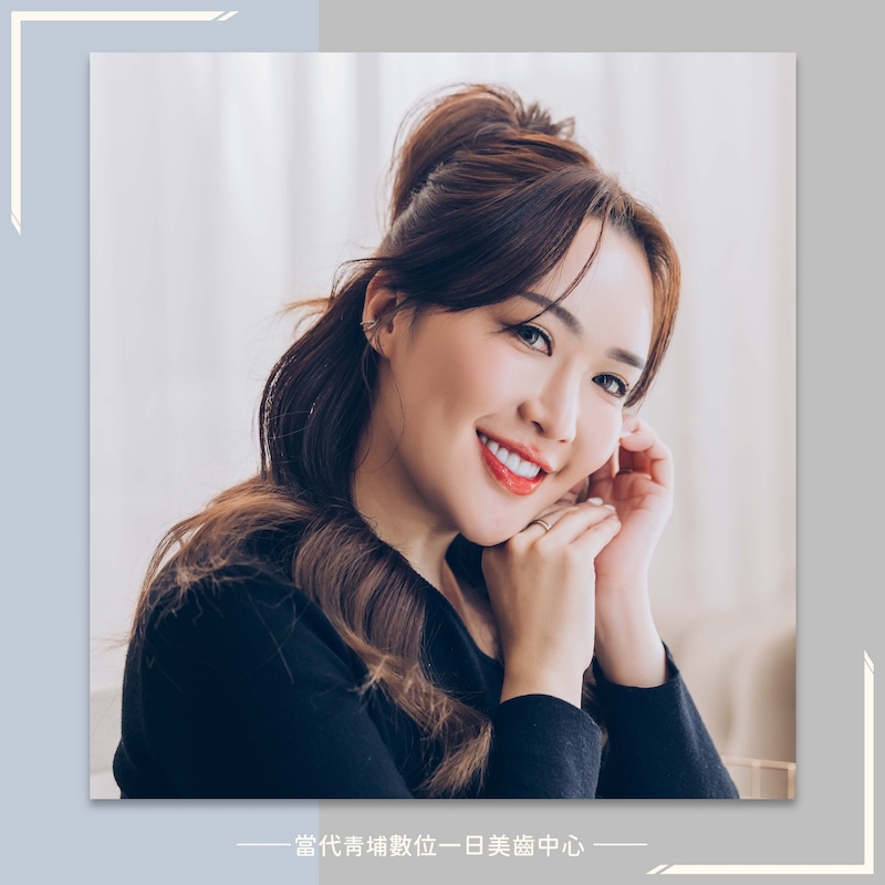 高雄患者來桃園完成陶瓷貼片，露出白皙自然的微笑曲線牙齒