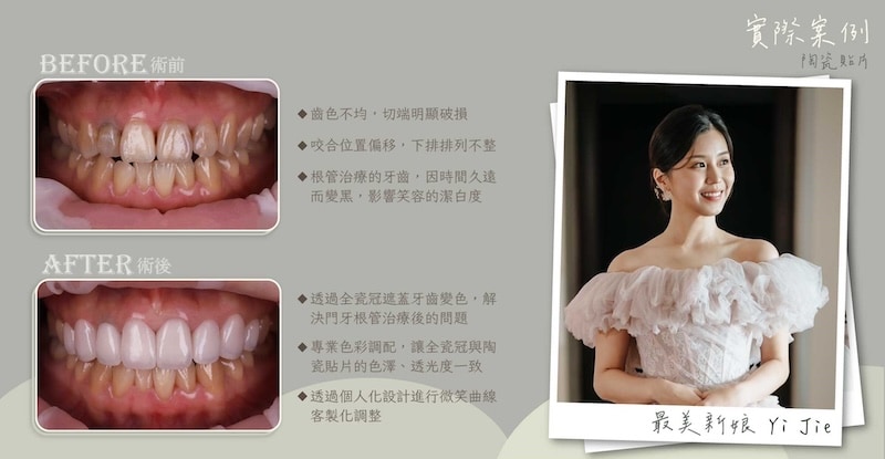 陶瓷貼片療程前後對比,改善牙齒排列與色澤,展現自然協調的笑容
