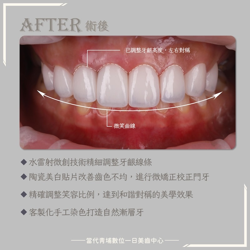 樂天女孩心韻陶瓷貼片術後效果，牙齦線條左右對稱、牙齒潔白透亮、微笑曲線自然和諧